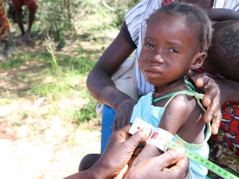 Fighting Severe Malnutrition In Southern Angola Southern Africa Hunger Emergency Response World Vision International