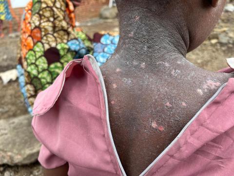 A girl, in a pink dress, sits outside a medical tent awaiting her screening for mpox