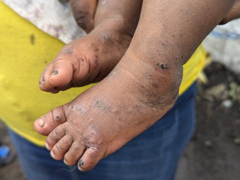 Le pied d'un enfant souffrant de Mpox